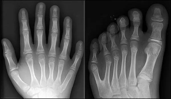 En hand med sex fingrar, en fot med sex tår. Röntgenbilder.