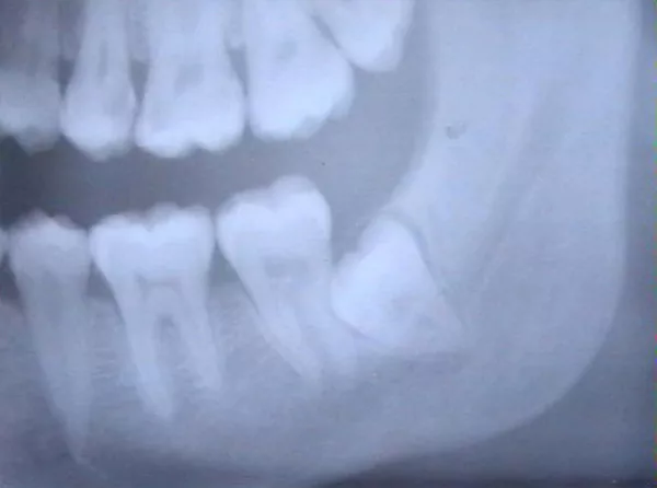 Röntgenbild av käke med tänder. Foto.