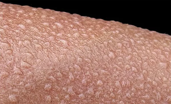 Närbild på svettdroppar på hud. Foto.